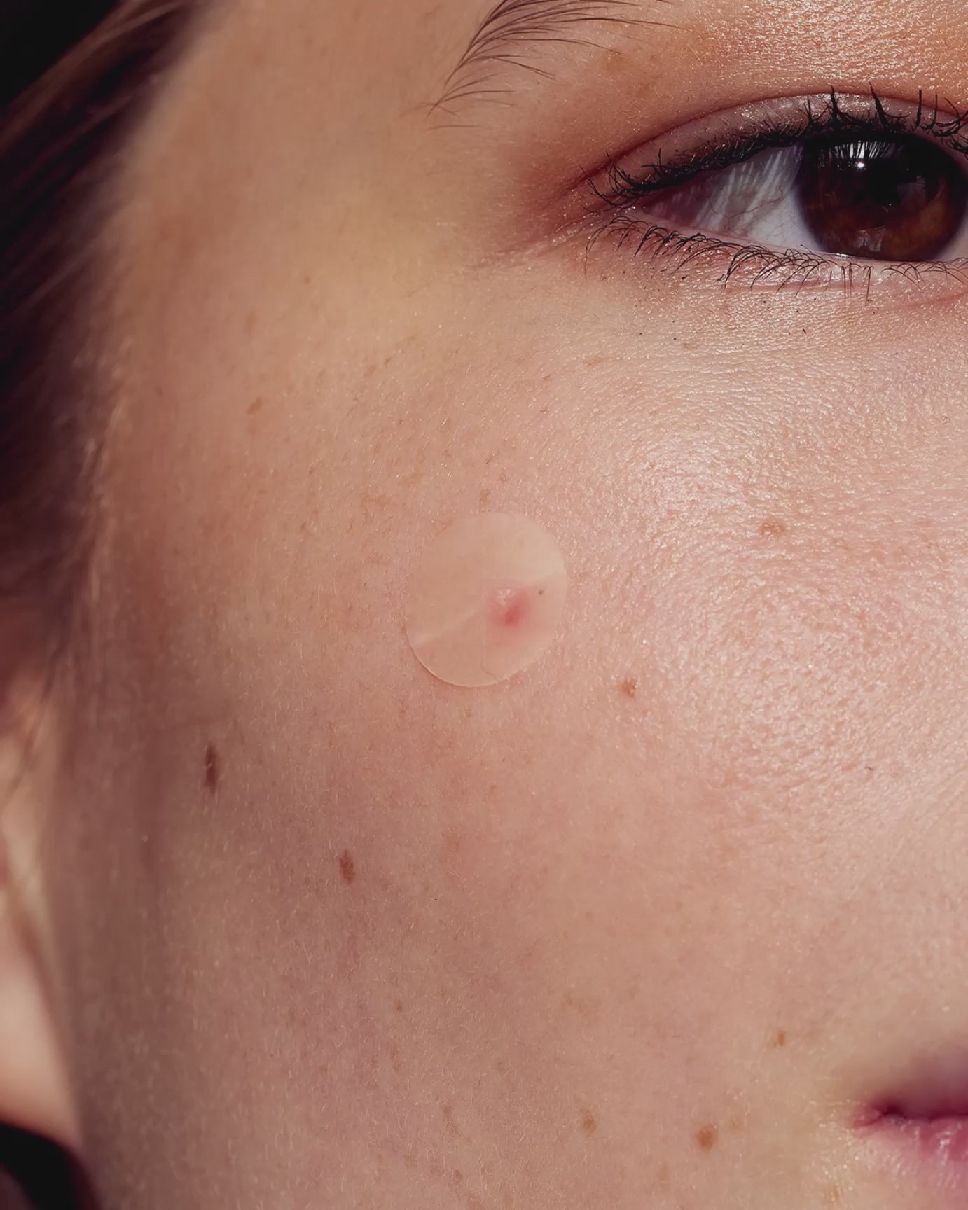 Indlæs video: Bumser og urenheder absorberes på kun 6-8 timer eller over natten.